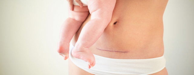 La césarienne tout savoir