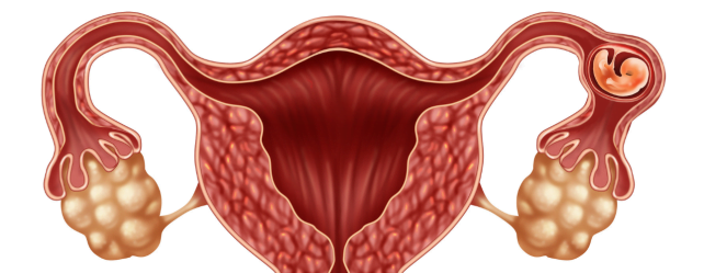 La grossesse extra-utérine