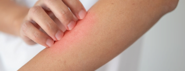 Allergie aux acariens: tout savoir